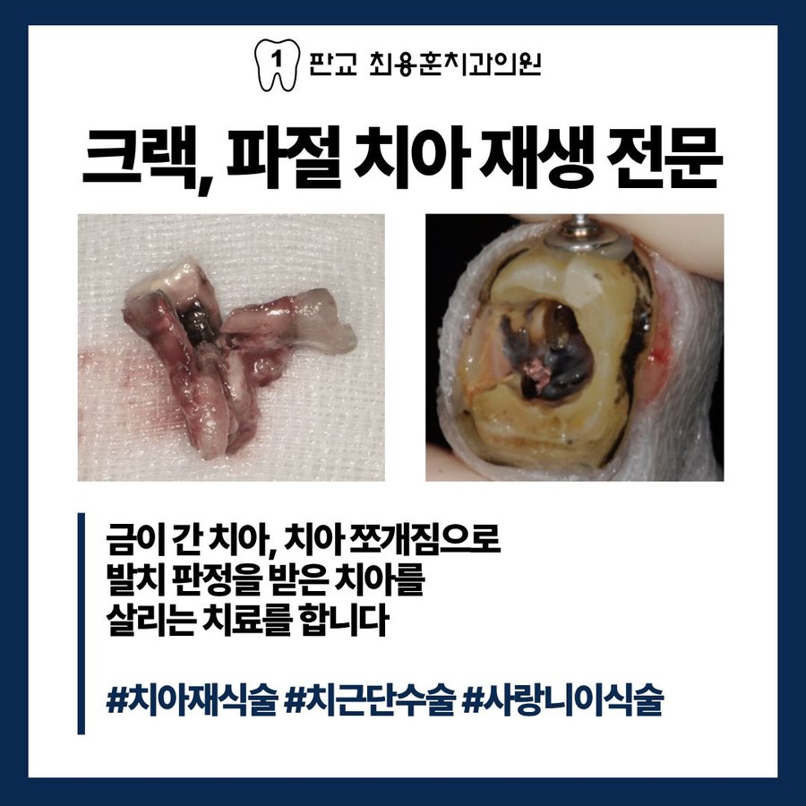 크랙·파절 치아 재생 전문 — 금이 간 치아, 치아 쪼개짐으로 발치 판정을 받은 치아를 살리는 치료